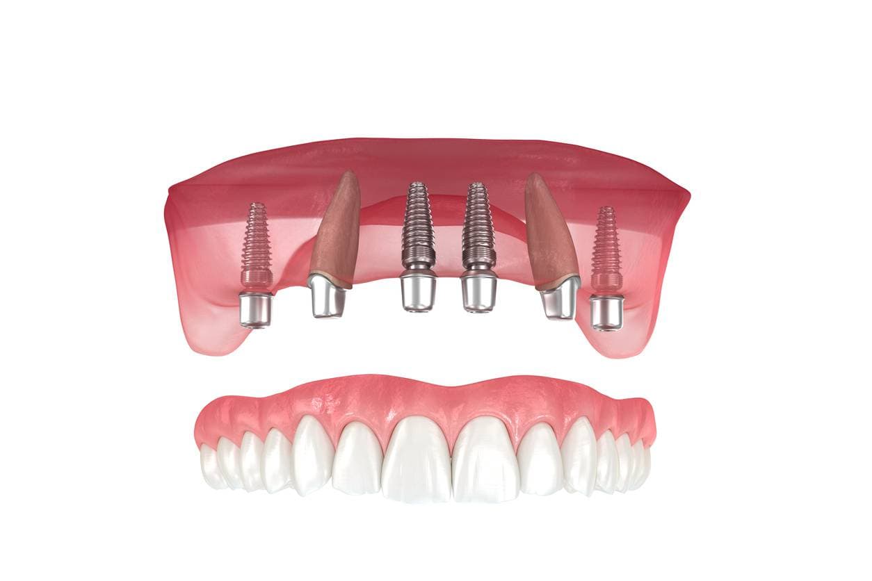 Custom-fitted comfortable dentures