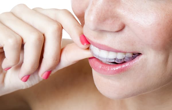 Invisalign clear aligners