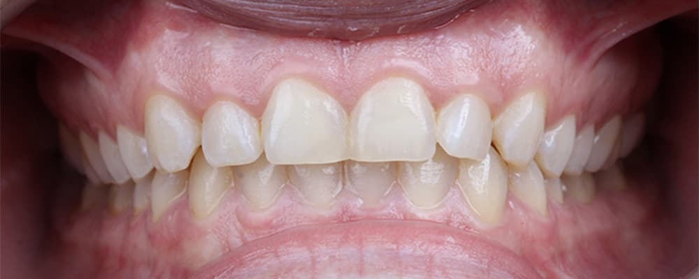Lifetime guaranteed dental crown