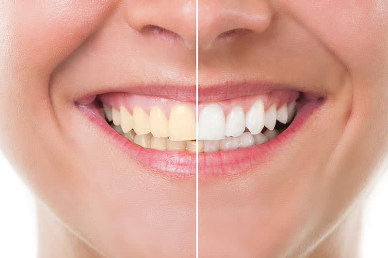 Teeth whitening results